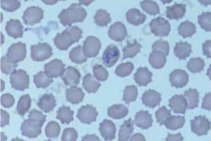Anémie hémolyque à médiation immunes