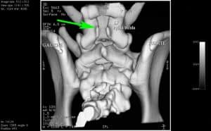 Spina bifida chez un Bulldog anglais
