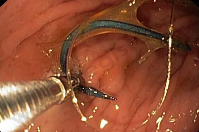 Faire vomir son chien en cas d'intoxication, de corps étranger