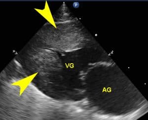 Cardiomyopathie hypertrophique ou Myocardiopathie hypertrophique (CMH ou HCM) chez le Mau égyptien