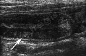 Lymphangiectasie intestinale chez le chien
