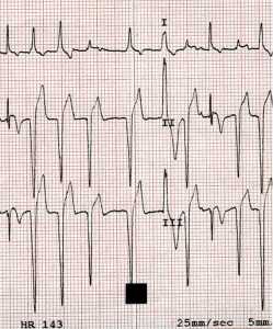 Électrocardiogramme (ECG) : grave trouble du rythme cardiaque chez un chien intoxiqué par un raticide (scilliroside).